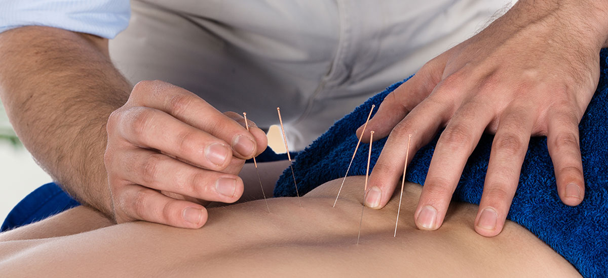 Chiropractor applying acupuncture needles to the small of the back